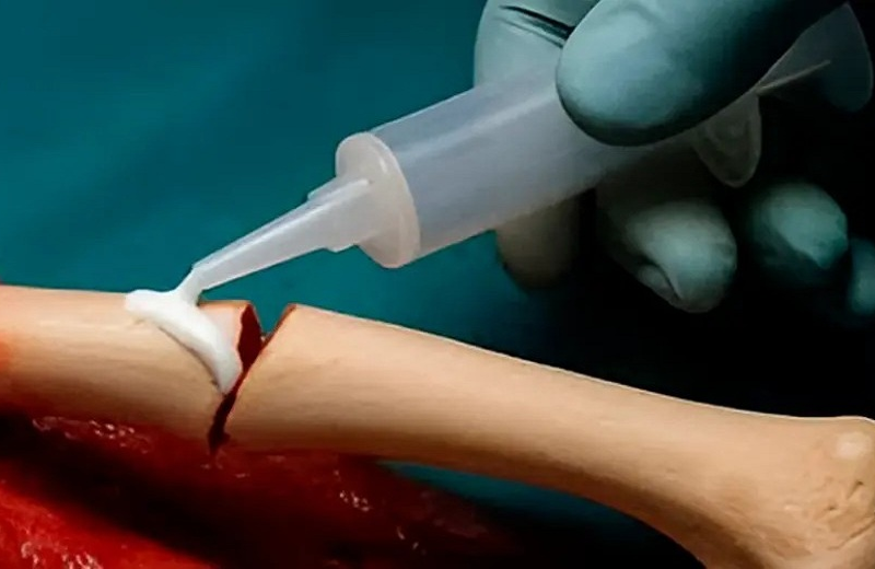 Pegamento para huesos hecho en China alivia fracturas en tiempo récord (+Detalles)